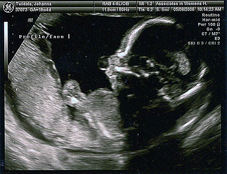 24 week hd ultrasound